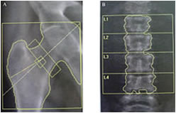 osteoporosi diagnosi