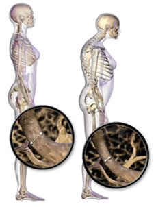 osteoporosi