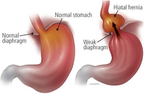 Diagnosi ernia iatale