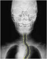 Diagnosi gozzo