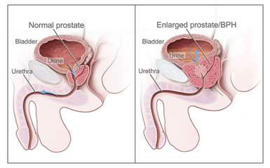 Diagnosi ipertrofia prostatica