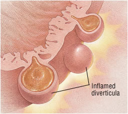 Diverticolite