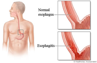 Esofagite
