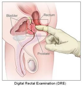 Esplorazione rettale prostata