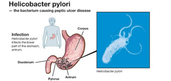 Helicobacter pylori