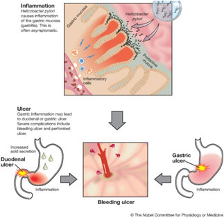 Helicobacter pylori Gastrite