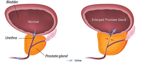 Ipertrofia prostatica benigna