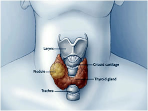 Noduli tiroidei