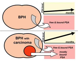 PSA tumore prostata