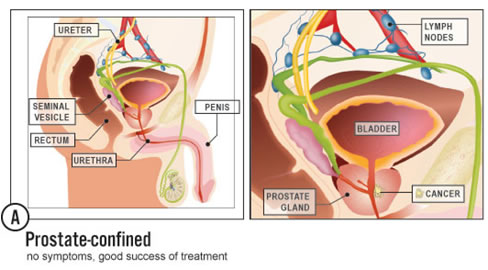 Sintomi tumore prostata