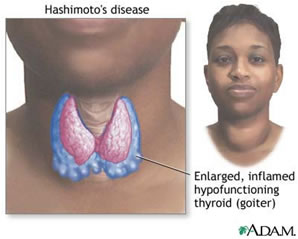 Tiroidite di hashimoto