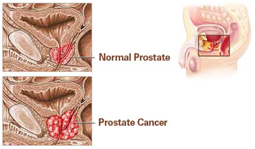 Tumore della prostata