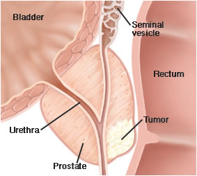 Tumore prostata