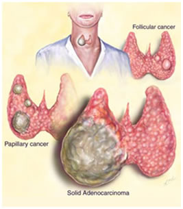Tumori maligni tiroide