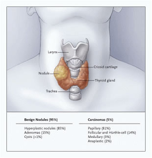 Tumori tiroide