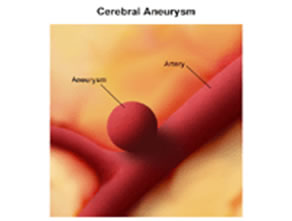 Aneurisma Cause e Fattori di Rischio