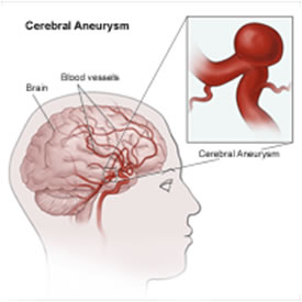 Aneurisma Cerebrale
