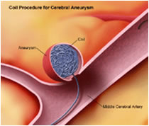 Aneurisma coiling