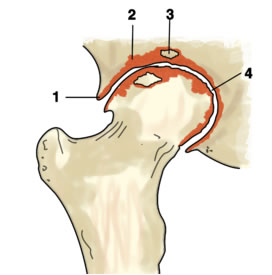 Artrosi dell'anca