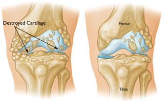 Artrosi al Ginocchio