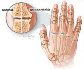 Artrosi della mano