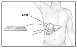 Biopsia Epatica
