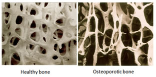 cause osteoporosi