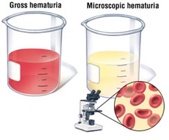 cistite emorragica