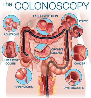 Applicazioni Colonscopia