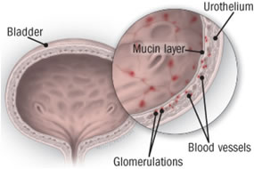 diagnosi cistite interstiziale