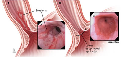 diagnosi esofagite