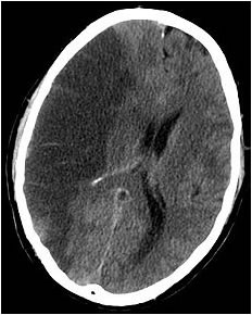 Diagnosi ischemia cerebrale