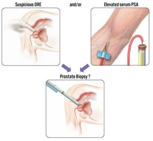 diagnosi tumore prostata