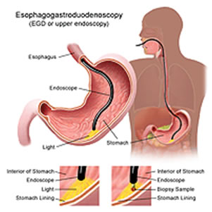 diagnosi ulcera duodenale