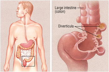 diverticoli