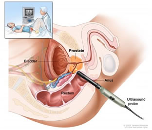 ecografia prostatica