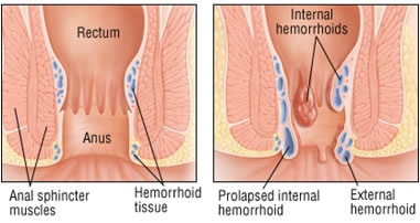 Emorroidi Prolassate