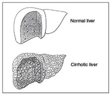 Fegato Normale e Cirrotico