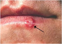 Herpes Labiale