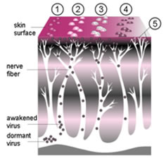 Herpes Zoster Pelle