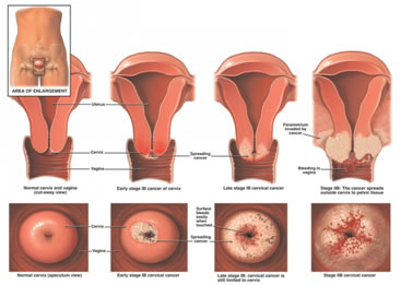 HPV - Papilloma Virus - Tumori