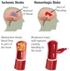 Ictus Ischemico Emorragico