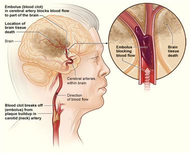 Ischemia cerebrale