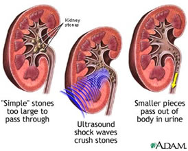 litotrissia calcoli renali