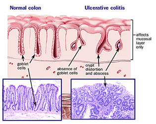 Mucosa intestinale colite ulcerosa