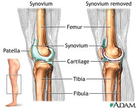 osteoartrosi