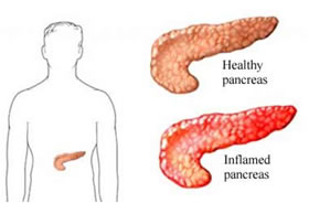 Pancreatite Acuta
