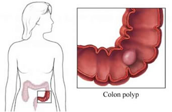 Polipi Intestinali