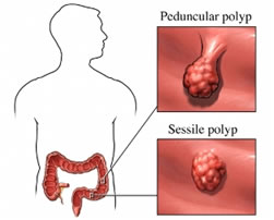 Polipi sessili peduncolati