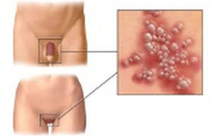 Sintomi herpes genitale